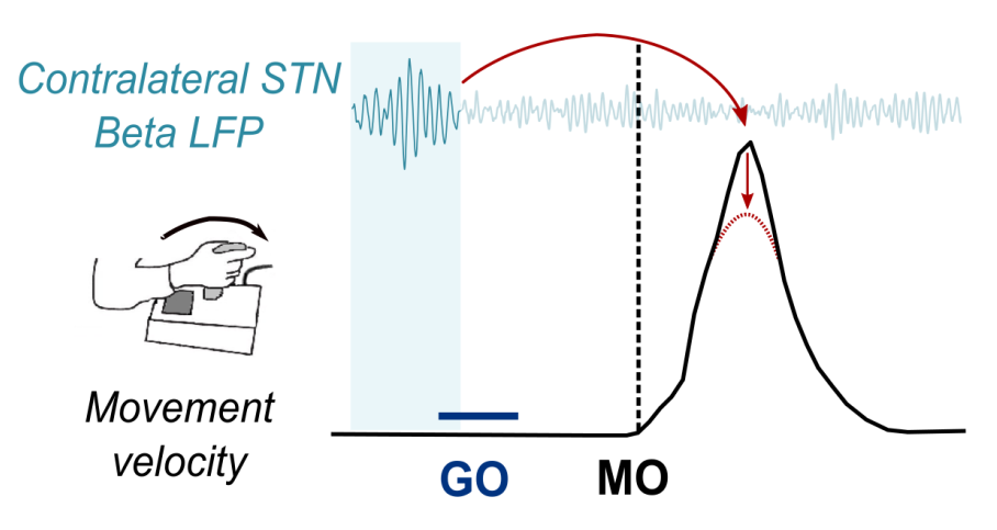 figure showing diagram of a hand on a joystick, and a plot of movement velocity vs. beta band activity in the LFP, and an indication that a beta burst before the go signal leads to reduced velocity in the movement.