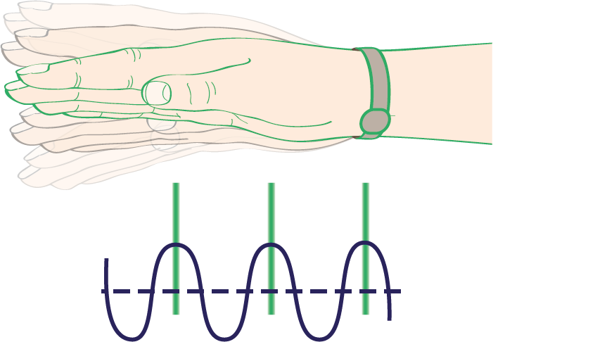 Upper panel shows a cartoon of a hand and wrist, with multiple drawings giving the illusion of the hand shaking up and down (a tremor). Lower panel shows a wavey purple line to represent a tremor movement, upon which three vertical lines are drawn to represent when median nerve stimulation was delivered.