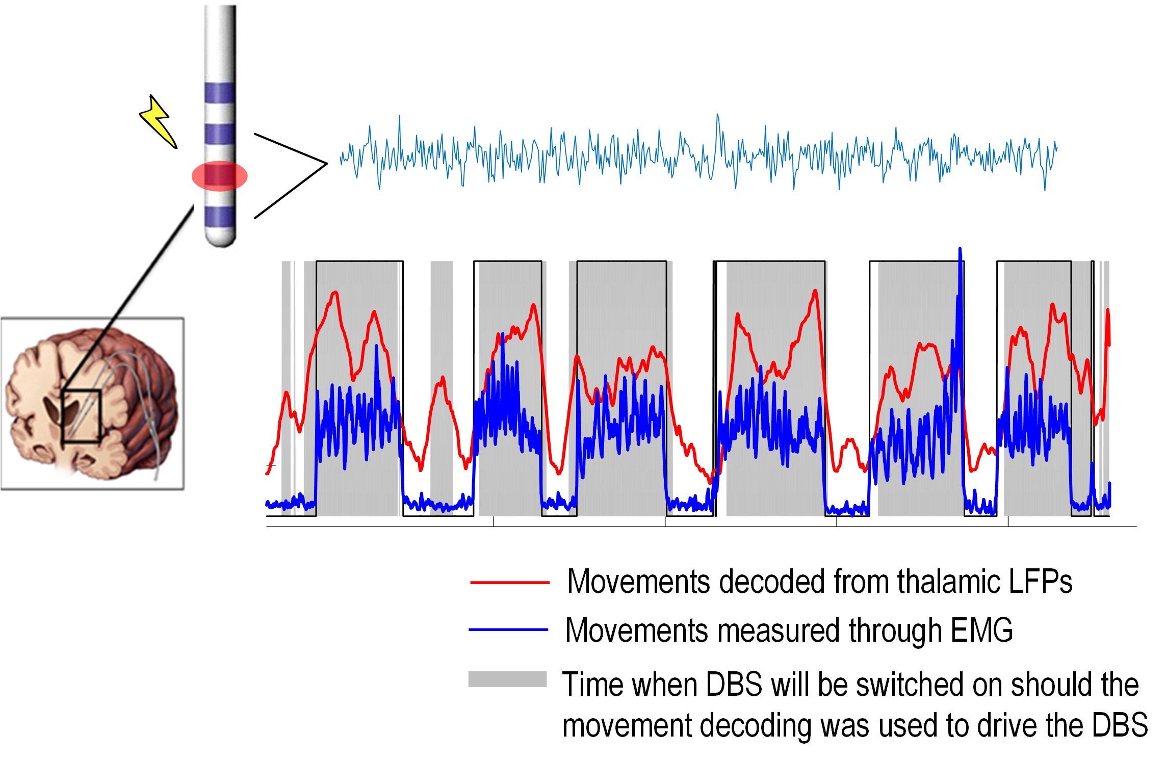 Local field potentials (LFPs) recorded from an electrode implanted in motor thalamus for therapeutic stimulation was used to identify whether the patient is making a voluntary movement or not. This matches very well the movements measured through muscle activities