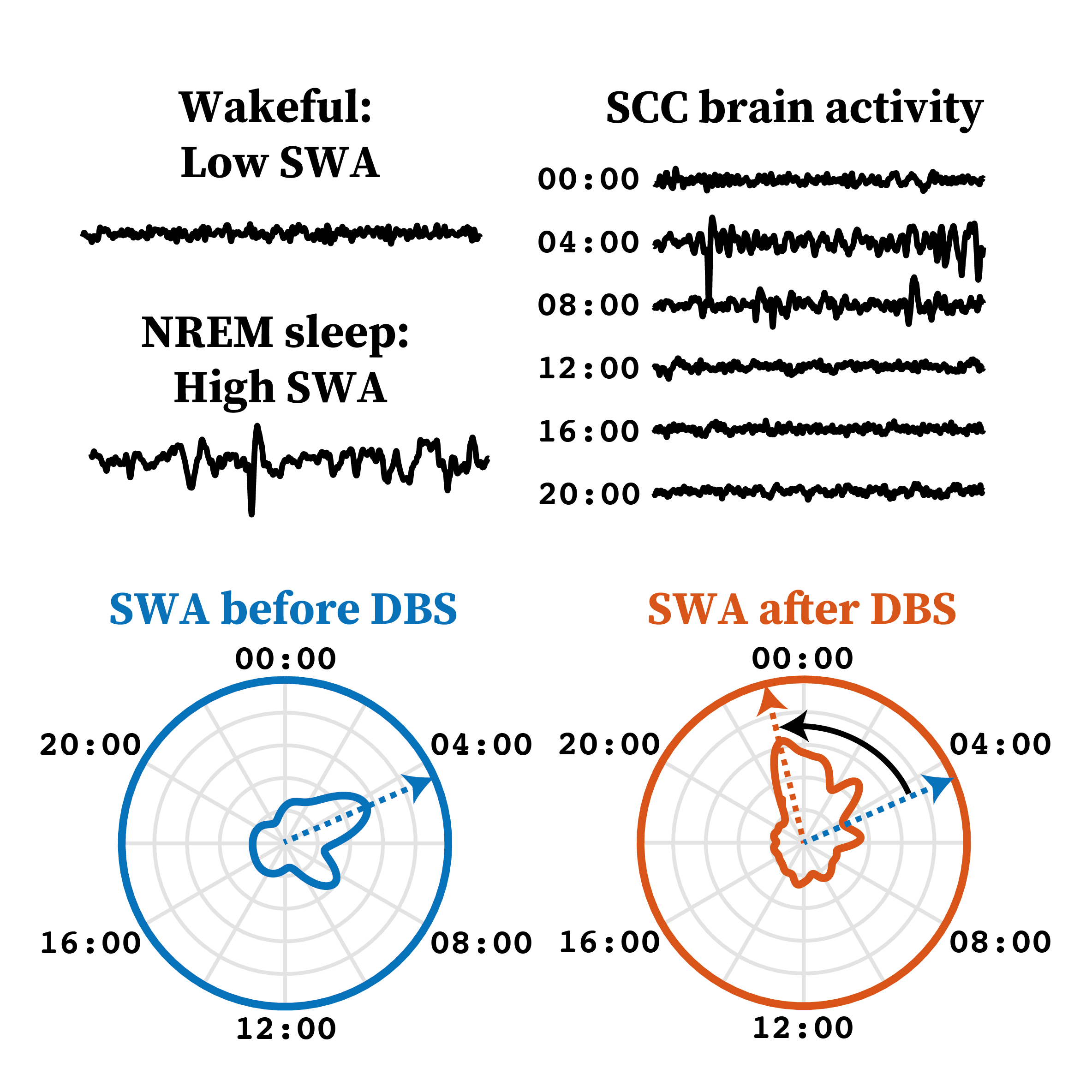 During deep sleep, the brain shows high slow-wave activity, or SWA. In patients undergoing deep brain stimulation (DBS) therapy of the subcallosal cingulate cortex (SCC) for depression, the brain stimulation implant captured brain activity at regular intervals before and after a 6-month period of therapy. We found that the peak of patients’ deep sleep occurred earlier in the night following successful DBS therapy.