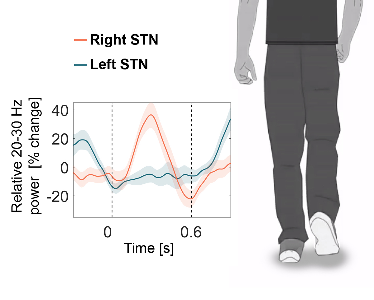 People with Parkinson’s stepped in place along with a cartoon man in a video (a screenshot of the video is displayed to the right). Brain activity was recorded from the subthalamic nucleus (STN) and showed that electrical waves occurring at 20-30 times per second (Hz) – so called ‘beta activity’ - alternated between the left and right STN (blue and red line) with the stepping movement.