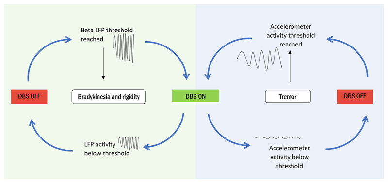 Adaptive Deep Brain Stimulation (DBS) uses brain signals (left) or muscle signals (right) to turn on stimulation when it is most needed.