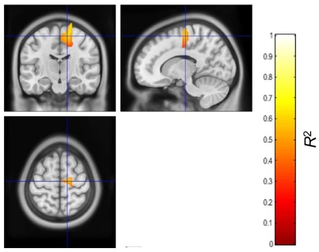 Three scans of a human brain, with coloured patches added to highlight the connections between certain brain areas.