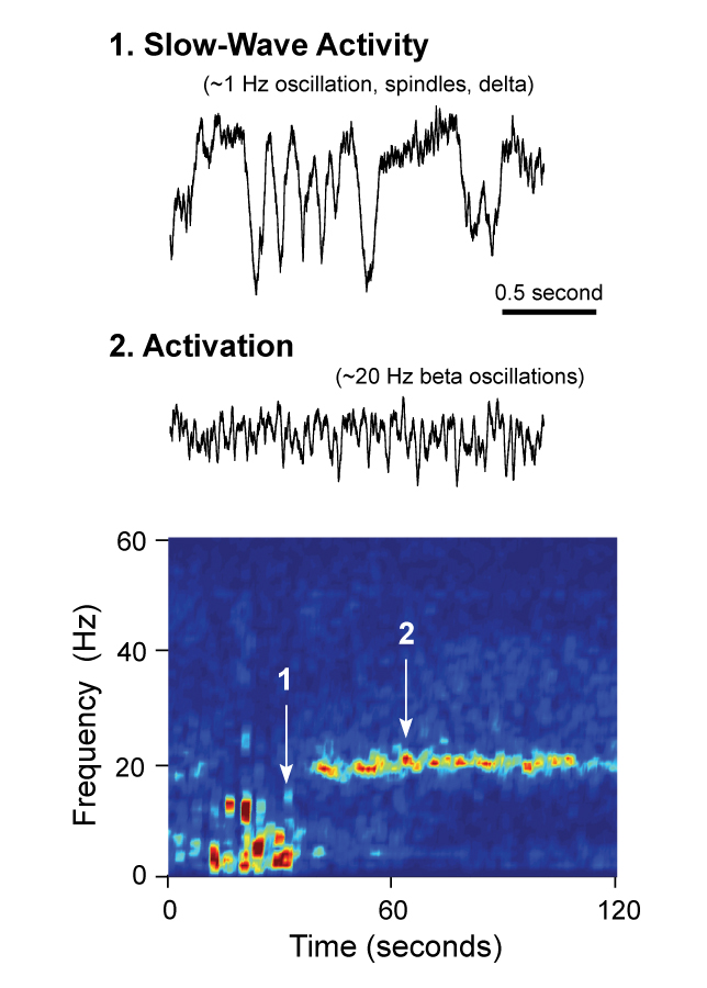 ‘Bad’ brain waves in Parkinsonism.