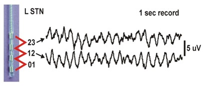 Picture of an electrode and brain rhythms