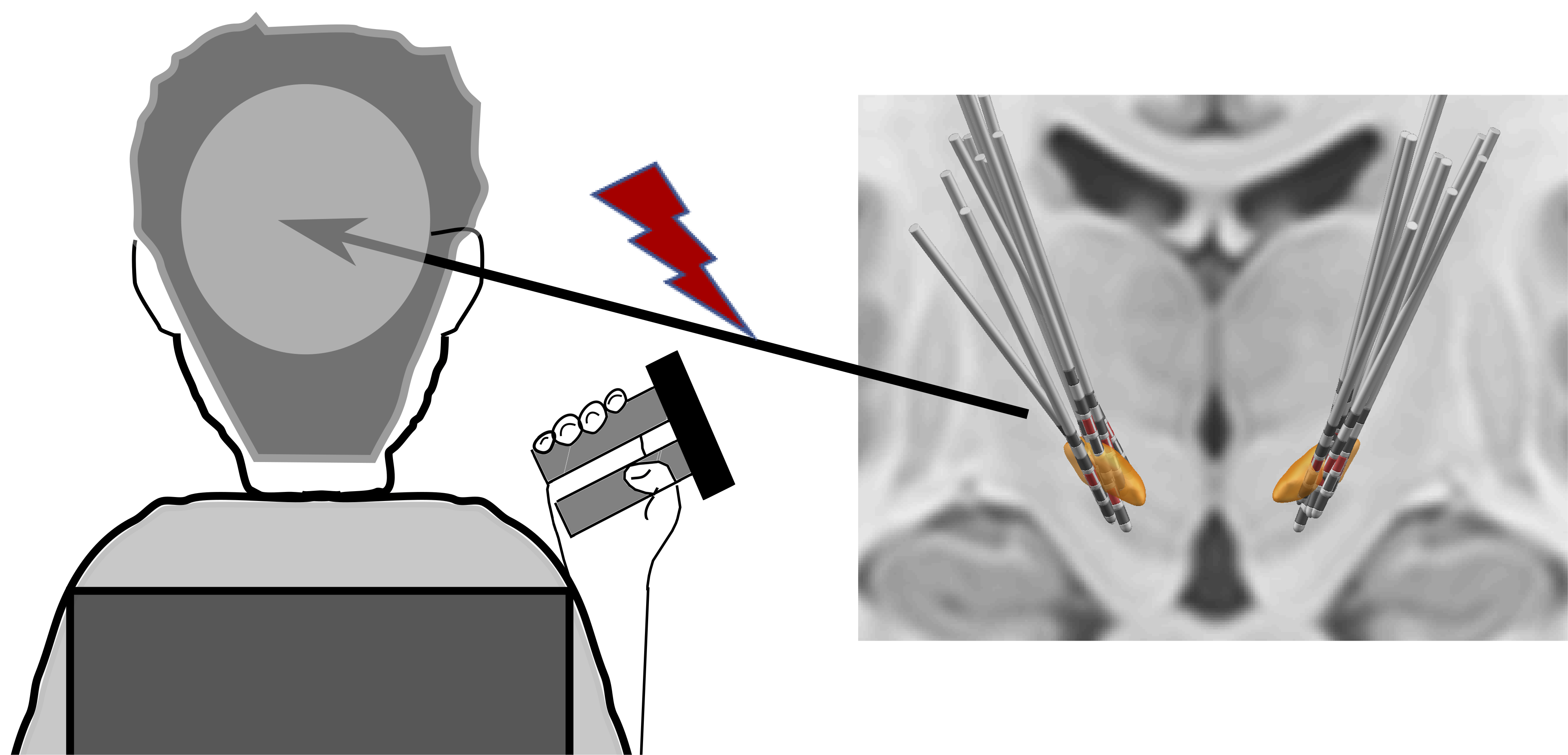 Left, schematic of person holding a force gripper in their hand; Right, schematic of electrodes implanted in deep brain structures