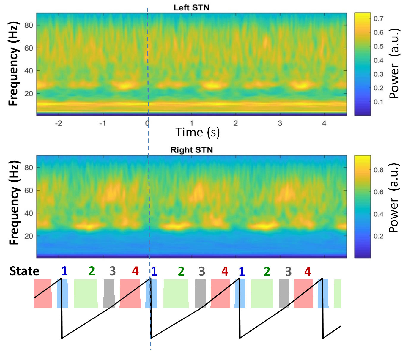 Brain signals recorded from the two subthalmic nuclei varying with the different phases of walking, shown as colour coded below.