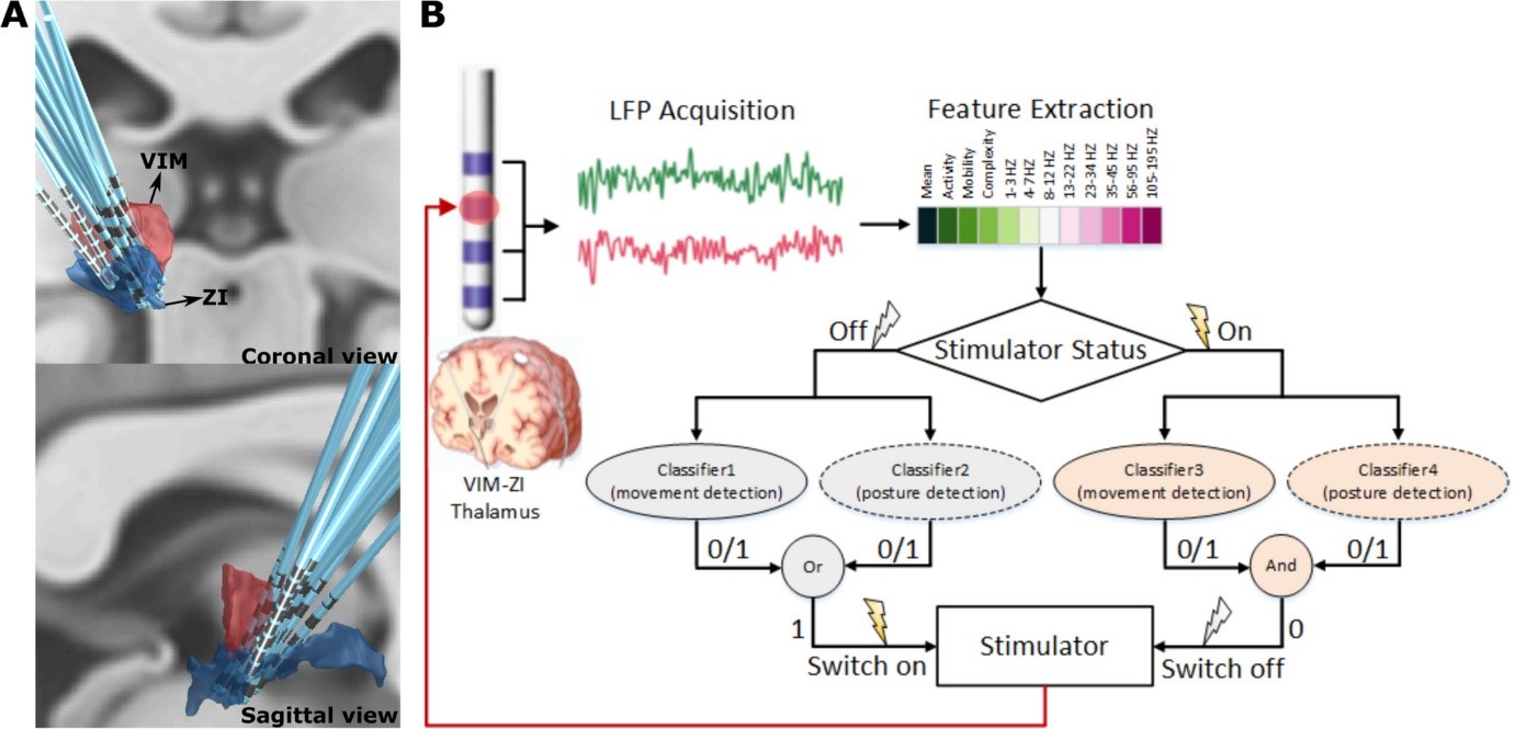 Picture of electrodes superimposed on a map of human brain, and a diagram showing steps for brain stimulation. 