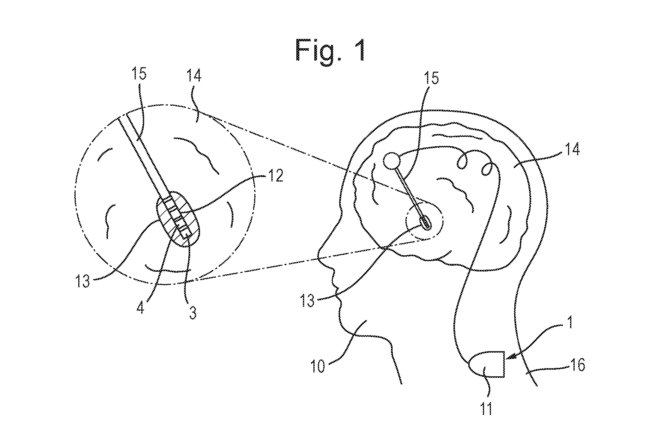 Diagram from the patent showing an electrode implanted in a human subject