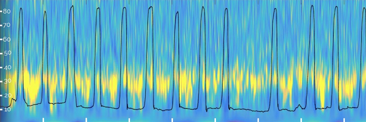 Recording of the local field potential activity in the human subthalamic nucleus during voluntary movement
