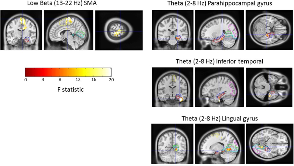 Pictures of human brain scans, with colours highlighting some brain regions.