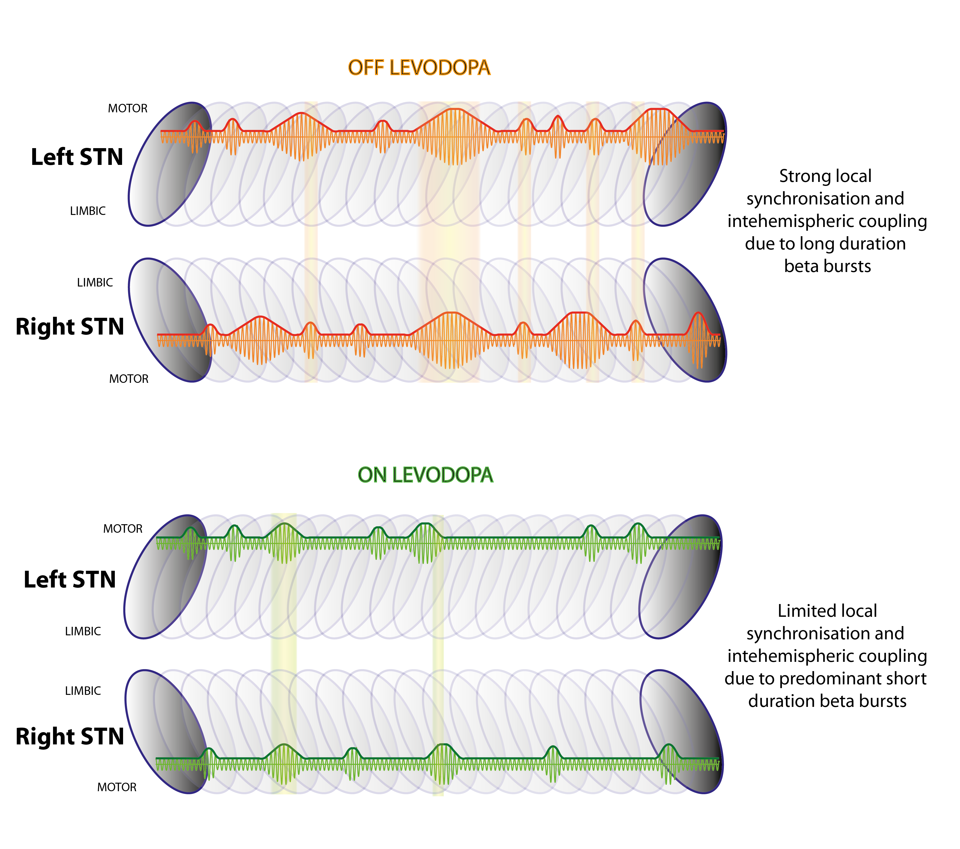 plots beta frequency activity of left and right STN under ON and OFF levodopa conditions- showing OFF results in strong local synchronisation due to long duration beta bursts, and ON having shorter bursts and limited synchronisation.
