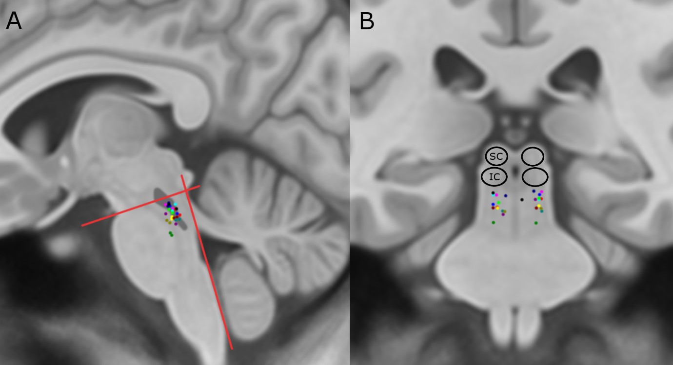 Anticipated locations of sites in the human brain that were targeted for therapeutic electrical stimulation (coloured dots), as looking from the side (A) or the front (B). The relative location of the pedunculopontine nucleus has been outlined in dark grey in the left panel.