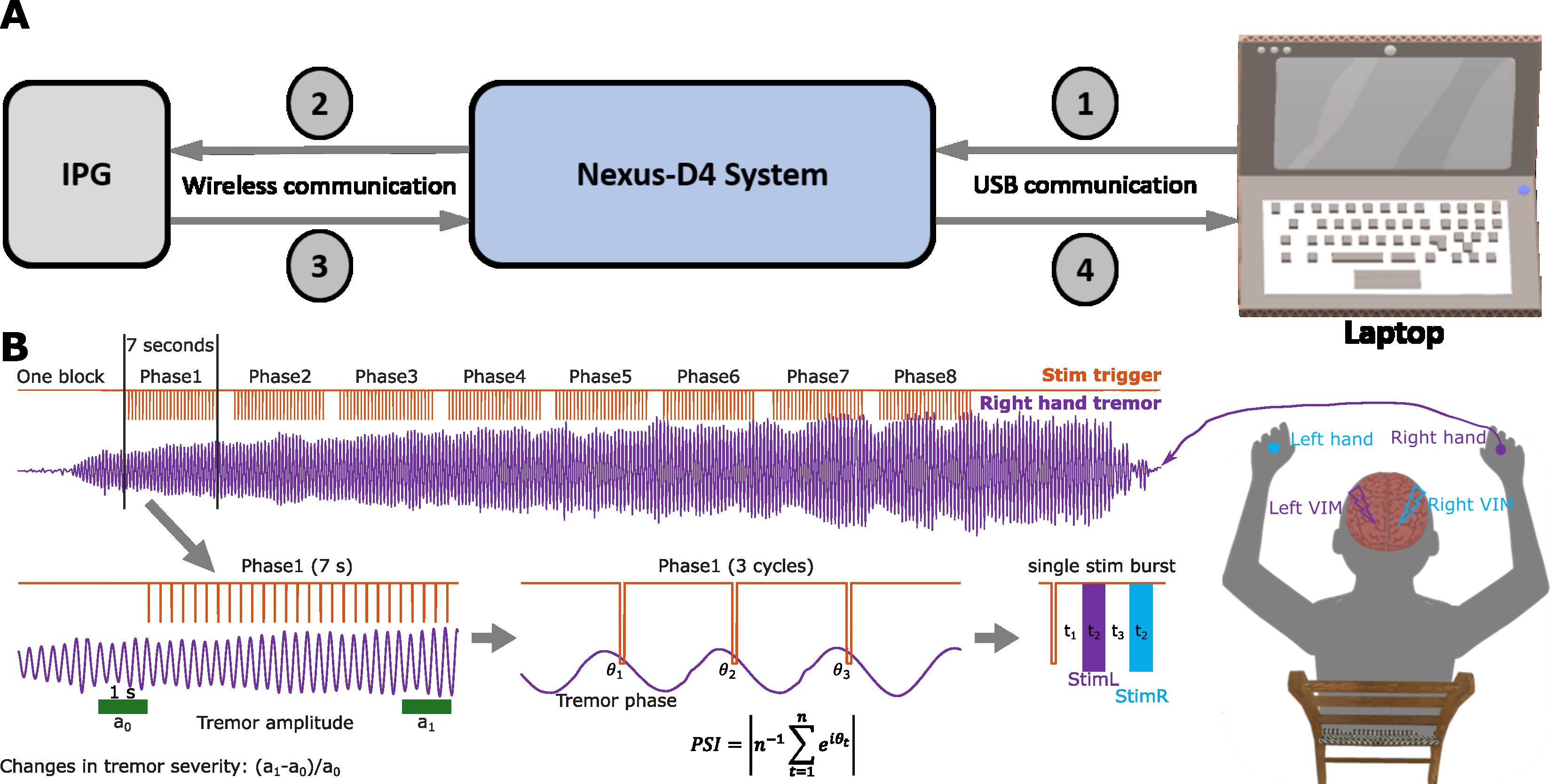 Protocol of tremor phase-locked deep brain stimulation (DBS) and its effect on tremor severity.