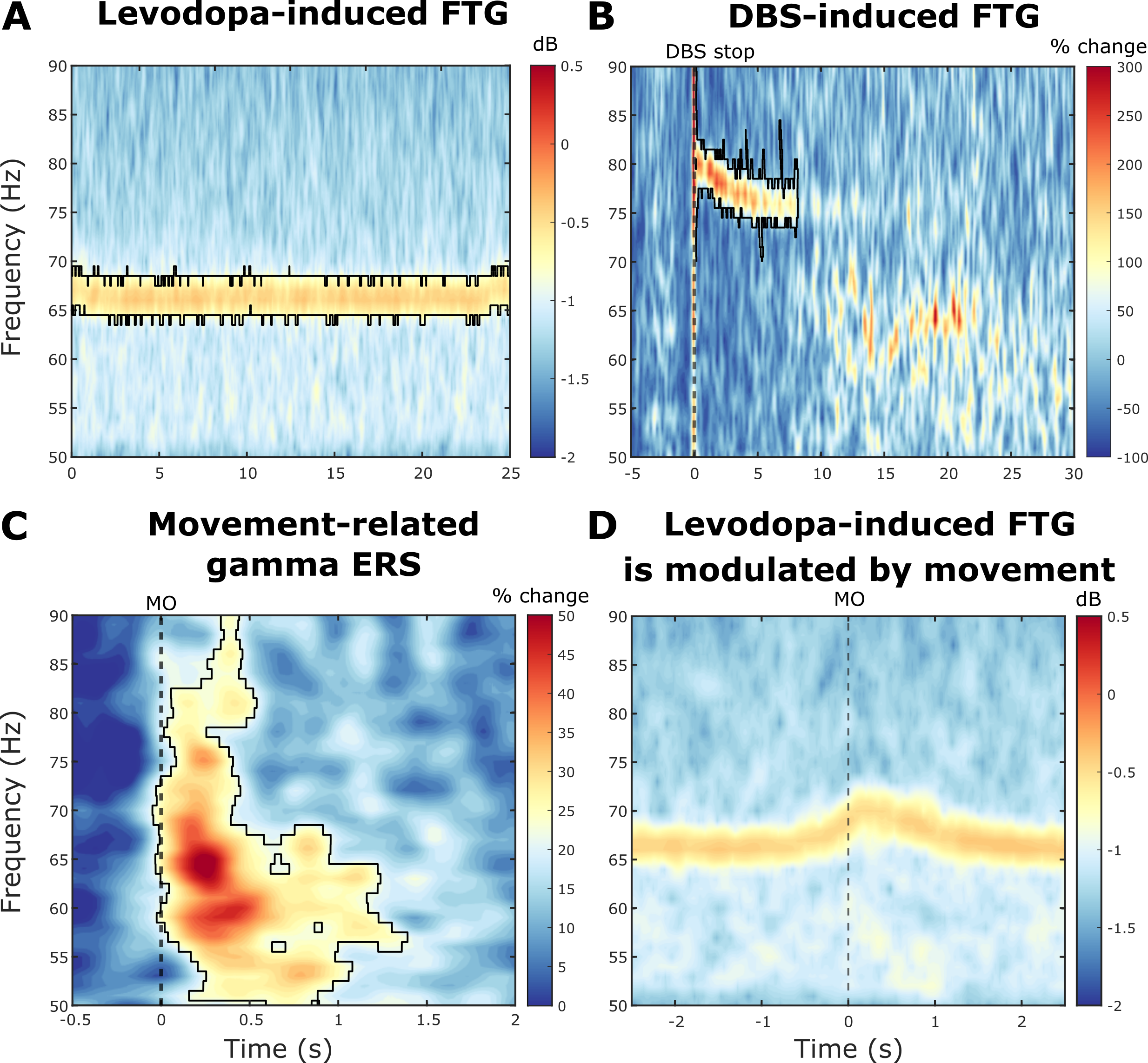 4 coloured data plots (spectrograms) showing how finely-tuned gamma oscillations change with therapeutic intervention and/or movement.