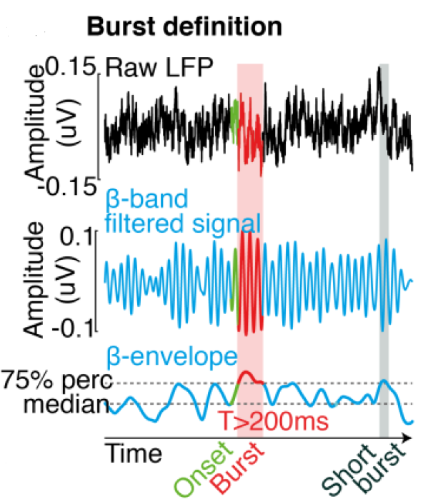 Definition of beta bursts