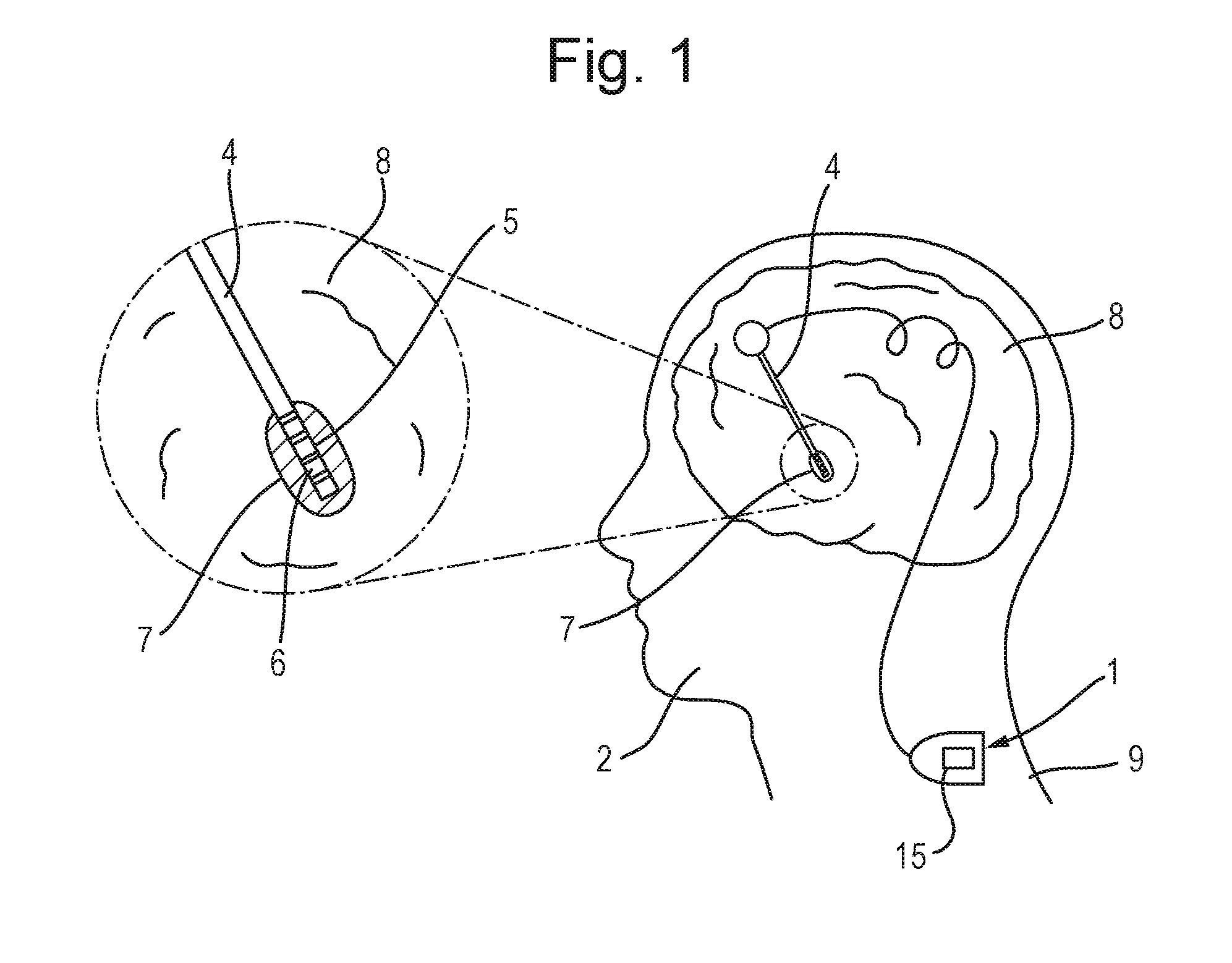 Figure 1 from the patent: a side view of a human head showing the impanted deep brain electrode and leads to an implanted device.