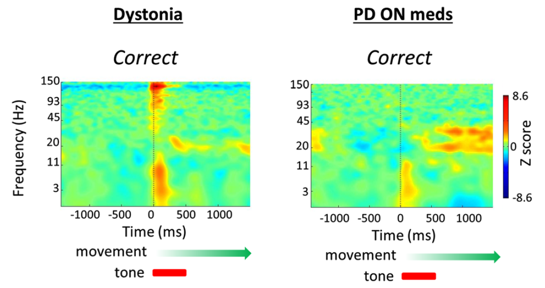 The Cognitive Role of the Globus Pallidus interna; Insights from Disease States.