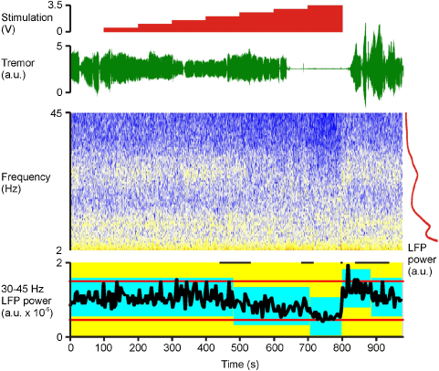 Tremor Reduction by Deep Brain Stimulation Is Associated With Gamma Power Suppression in Parkinson's Disease.