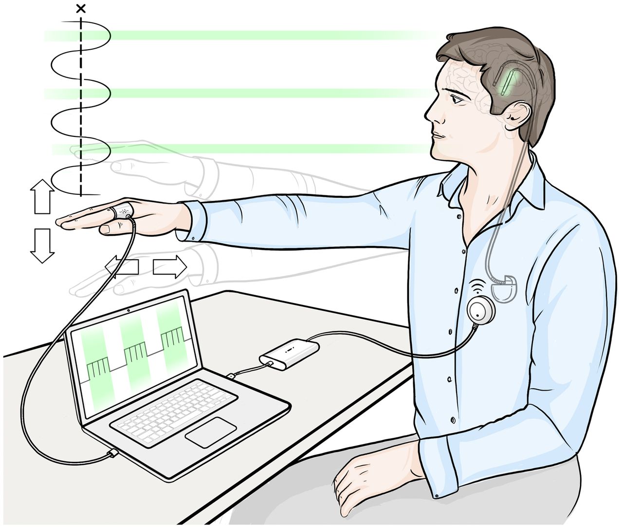 Phase-specific stimulation. A brain stimulator is controlled by a patient’s tremor, sensed using the accelerometer attached to the tremulous hand. The green segments indicate when a burst of stimulation is delivered to the thalamus in the brain. The exact timing of stimulation onset is locked to a particular tremor phase, and the interval between bursts corresponds to the patient’s tremor frequency.