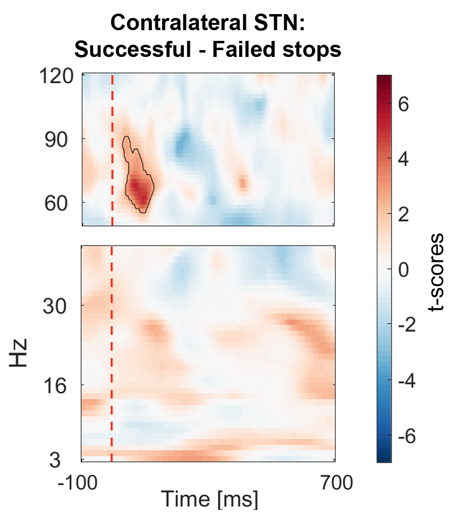 If a movement was successfully stopped after an auditory stop cue, which is represented by the red dashed line, there was an increase in brain oscillations at 60-90 Hz (see black outline). The part of the brain recorded here is called the subthalamic nucleus (STN).