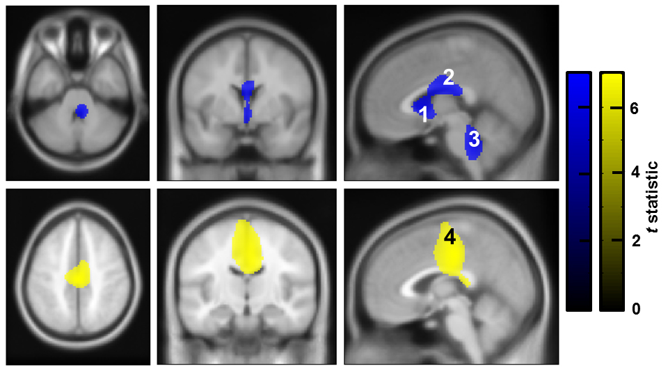 Brain regions with activity coupled to that in the pedunculopontine nucleus in different frequency bands (‘alpha-band’ coupling is shown in blue, and ‘beta-band’ coupling in yellow). Functional connectivity of the pedunculopontine nucleus is thus organised according to frequency.