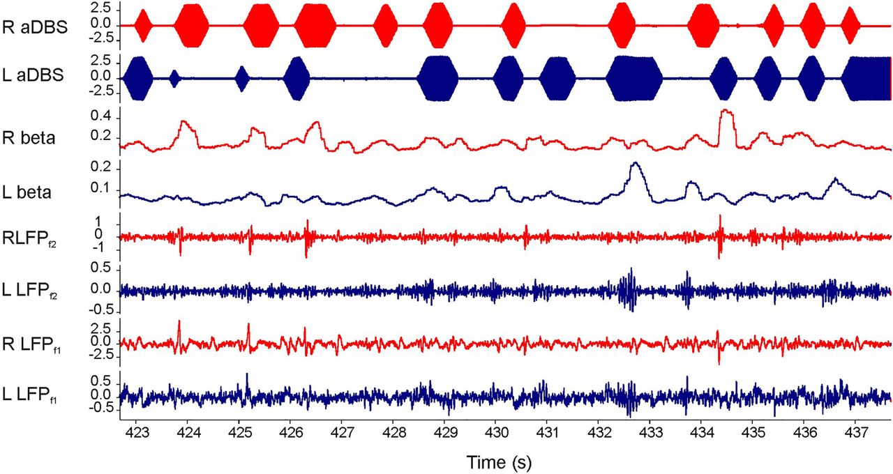 Screen shot of neuronal activity during 15 seconds of bilateral adaptive deep brain stimulation (aDBS). Bottom two traces are local field potentials (LFPs) after first-stage analogue filtering (LFPf1; 3-37 Hz). Third and fourth traces from bottom show LFPs after second-stage digital filtering around patient-specific peak in beta oscillations (LFPf2; 20 +/- 3 Hz). The two traces above (R beta and L beta) are the online readouts of the filtered beta oscillation amplitude after rectification, smoothing and thr