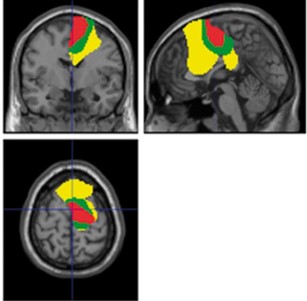 Group data showing significant areas of coupling between subthalamic region and rest of brain superimposed on MRI. Brain regions in yellow are those coupled at beta band (13-30 Hz) frequencies, regions in green are those where coupling is confined to the upper beta band (21-30 Hz), and regions in red are where coupling is suppressed by deep brain stimulation.