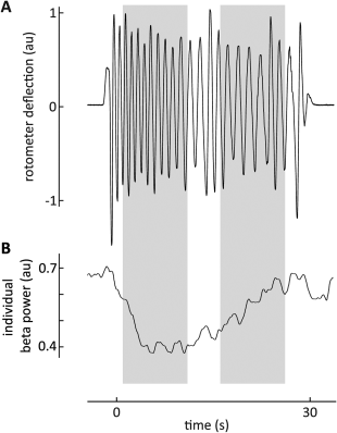 Top trace is the recording of repetitive wrist movements made by a person affected by Parkinson’s. There is a reduction in the size and frequency of the movements over time (bradykinesia). Lower trace shows the suppression in power of the beta-band oscillations recorded at the same time in the contralateral subthalamic nucleus. The suppression of beta-band power dissipates in tandem with the increase in bradykinesia.