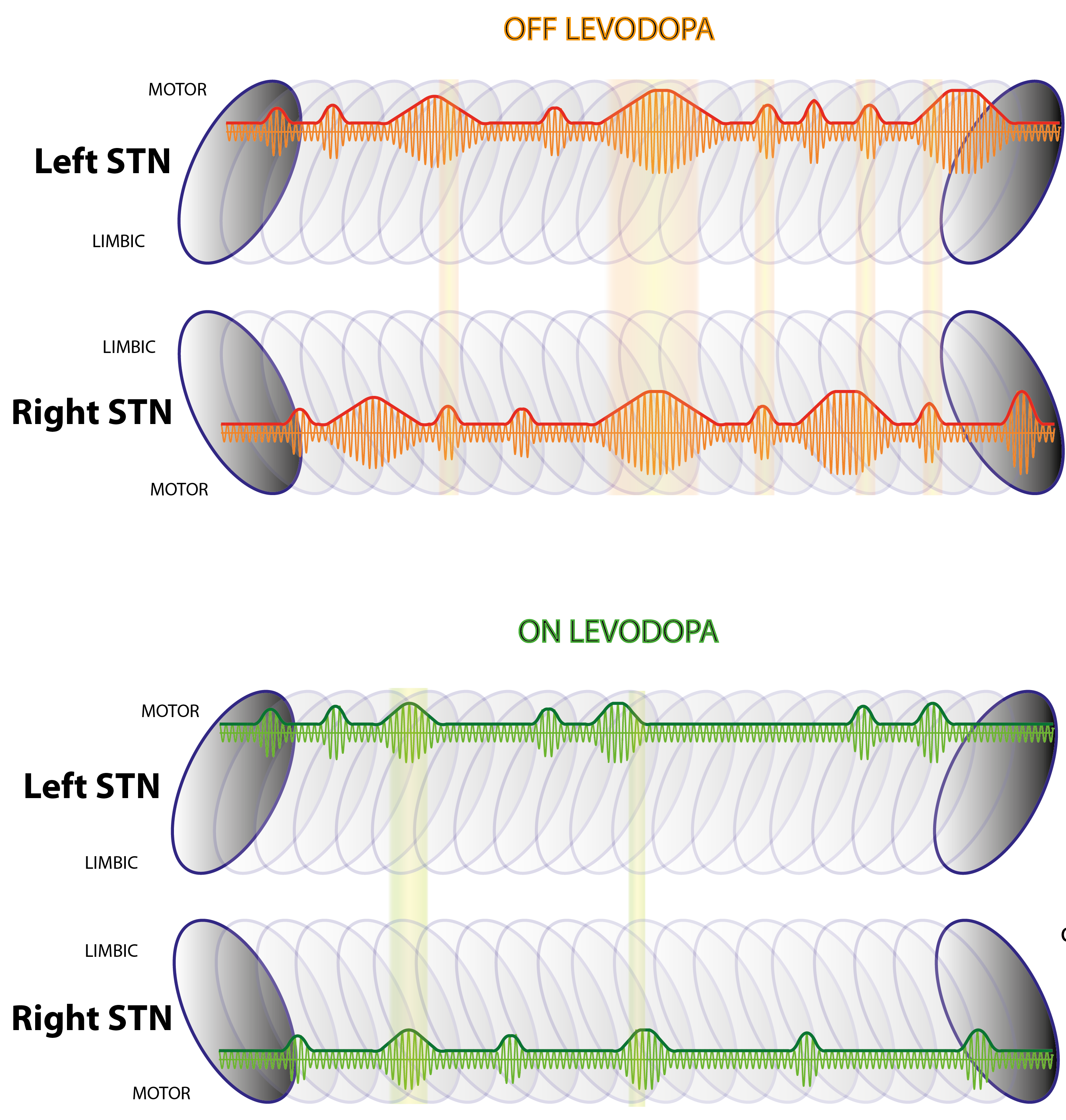 Beta burst dynamics in Parkinson's disease OFF and ON dopaminergic medication.