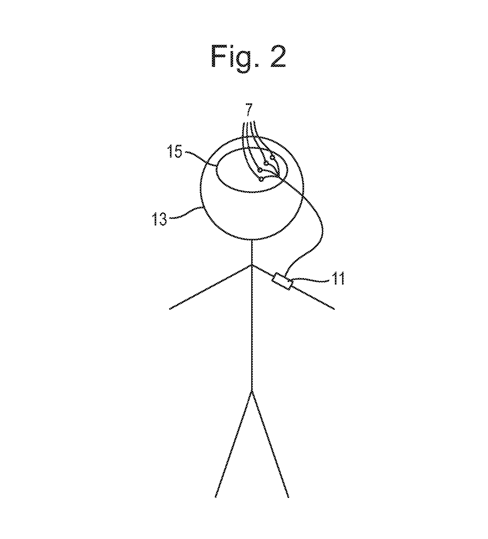 drawing of a stick man with 3 electodes implanted in brain, and external wire to a box on its arm.