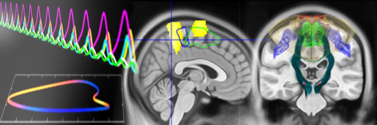 stylised image of brain waves in several colours representing frequencies, and structure MRI brain scan images overlaid with brain regions shaded in colours.