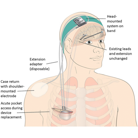 Cartoon of a person wearing a motion-adaptive neuromodulation system