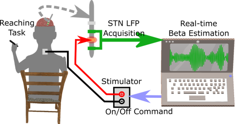 diagram of a participant seated doing the reaching task, with explanation of the data recorded from the DBS electrode feeding back to the stimulating contacts when beta reaches thresholds.