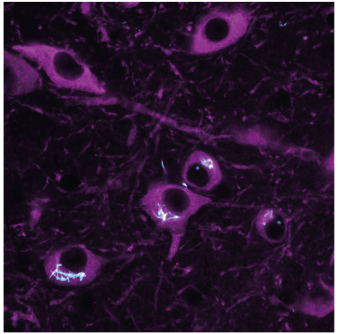 micrograph showing purple cells- fired-egg-like appearance with dark centres where the nucleus is. Clumps of spikey-looking material is showing in cyan, inside the cells.