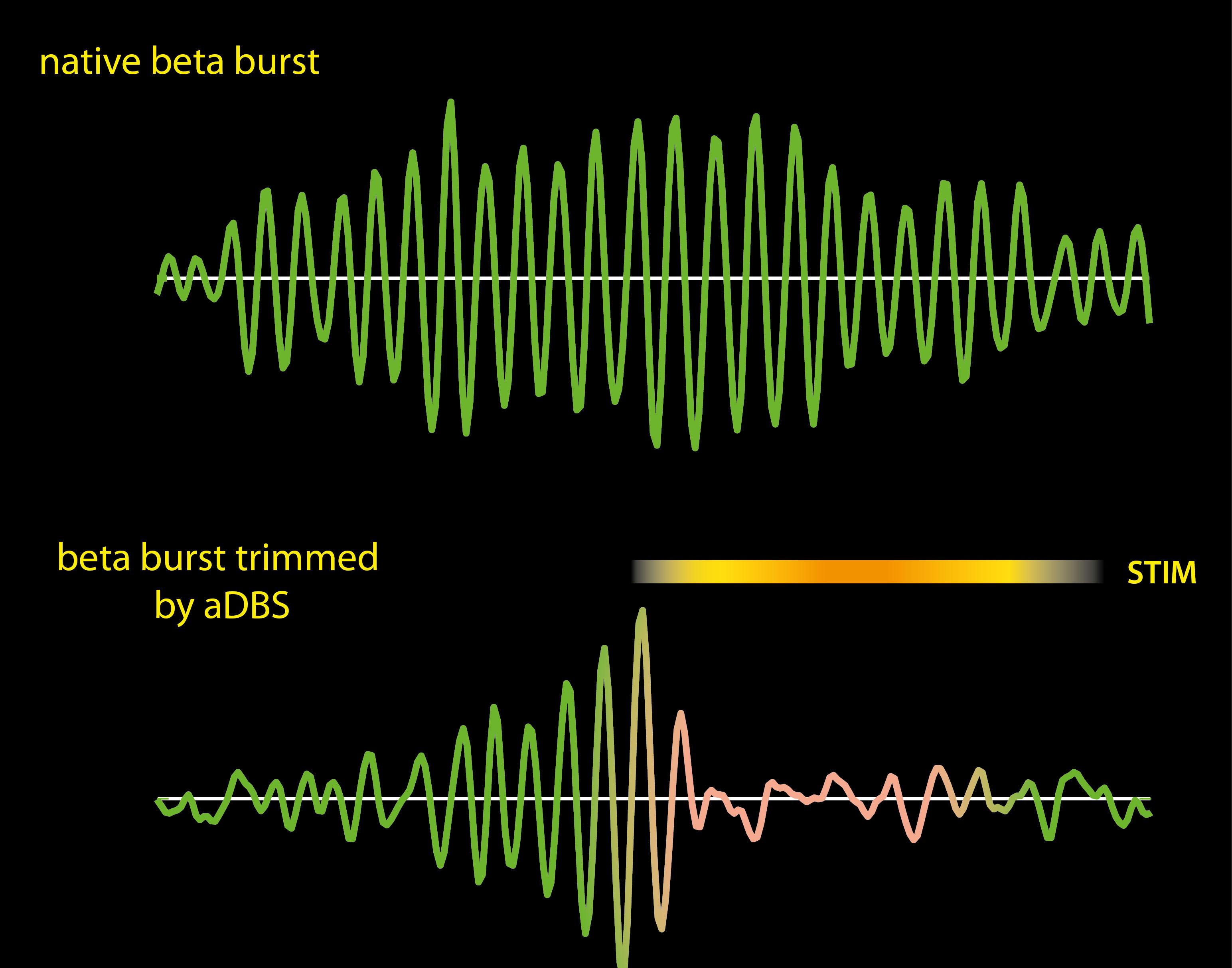 plot of beta frequency brain waves being reduced by adaptive deep brain stimulation